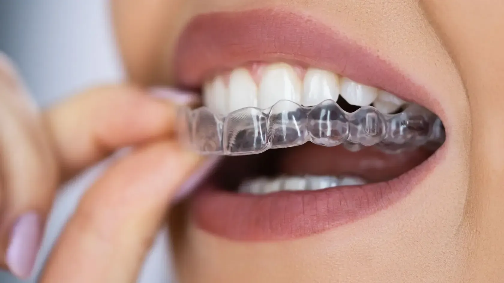 Woman inserting clear aligner into teeth.