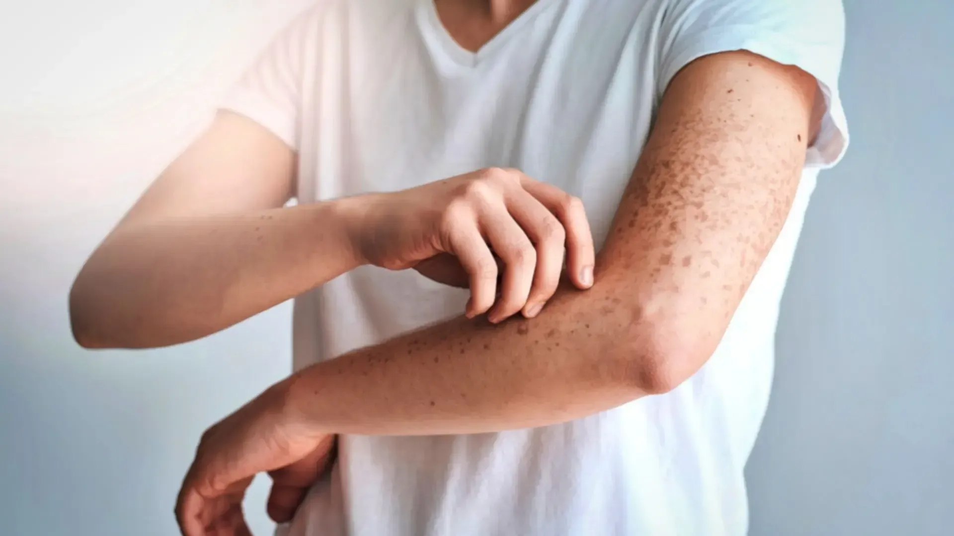 Person scratching arm with a rash, wearing a white t-shirt.