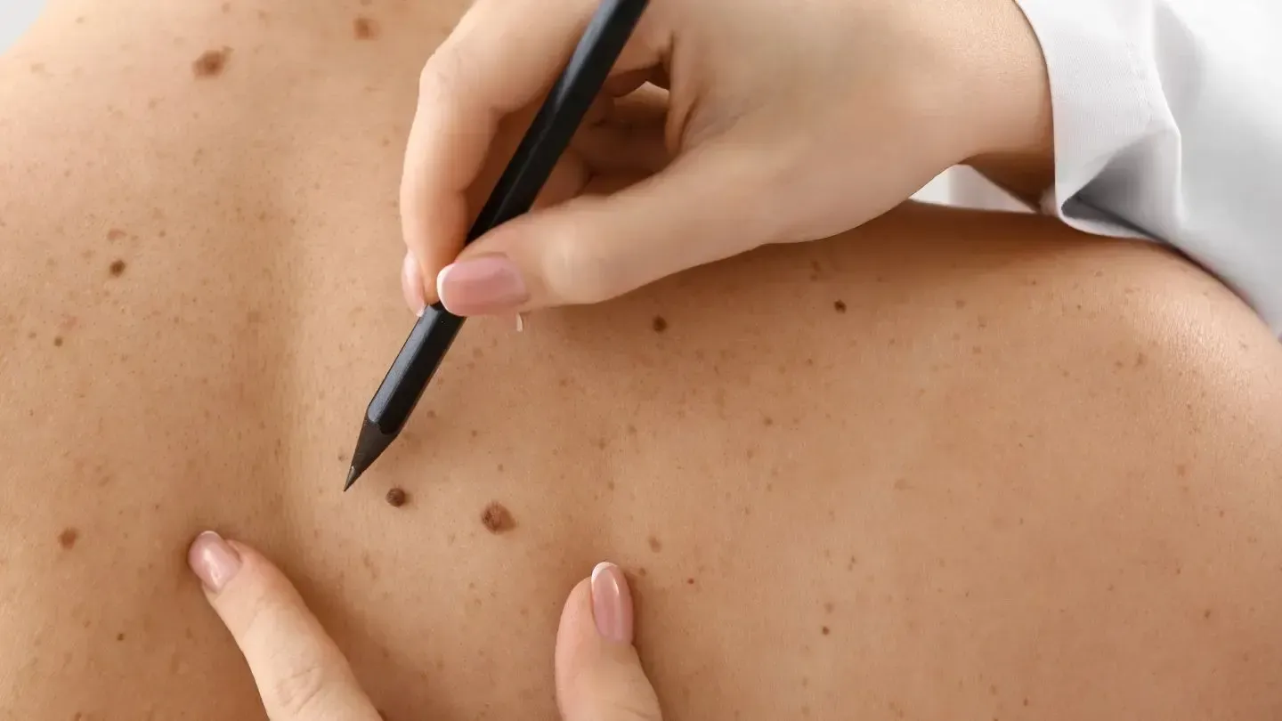 A doctor examining a person's back, using a pen to mark moles.