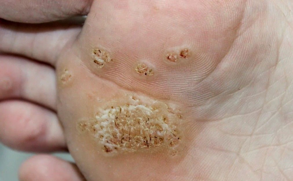 Hand wart treatment at 1 Health