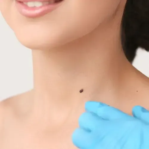 Person's neck with a mole being examined by gloved hand.