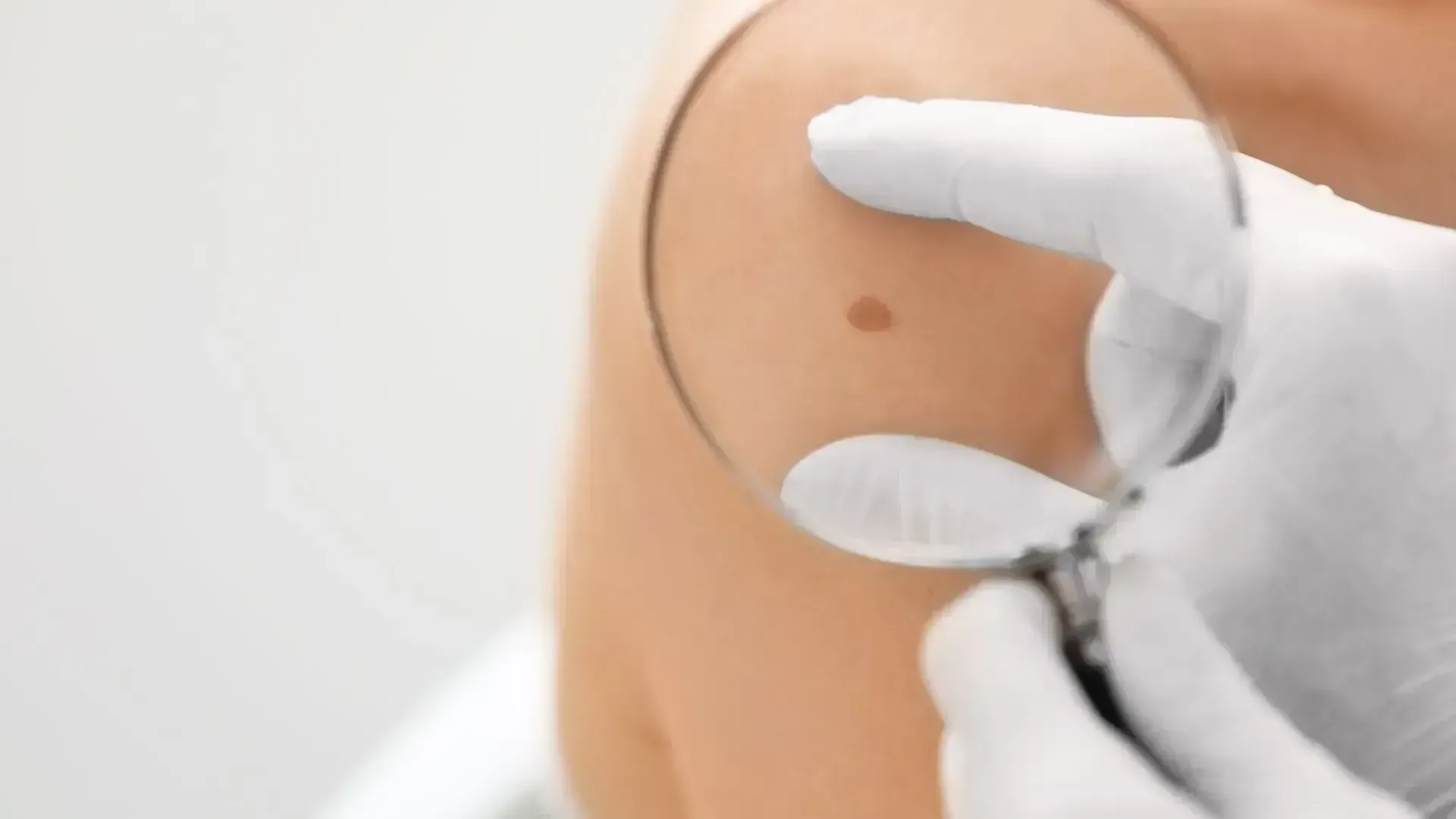 Summer Skin Checks & Mole Mapping Christchurch | 1 Health