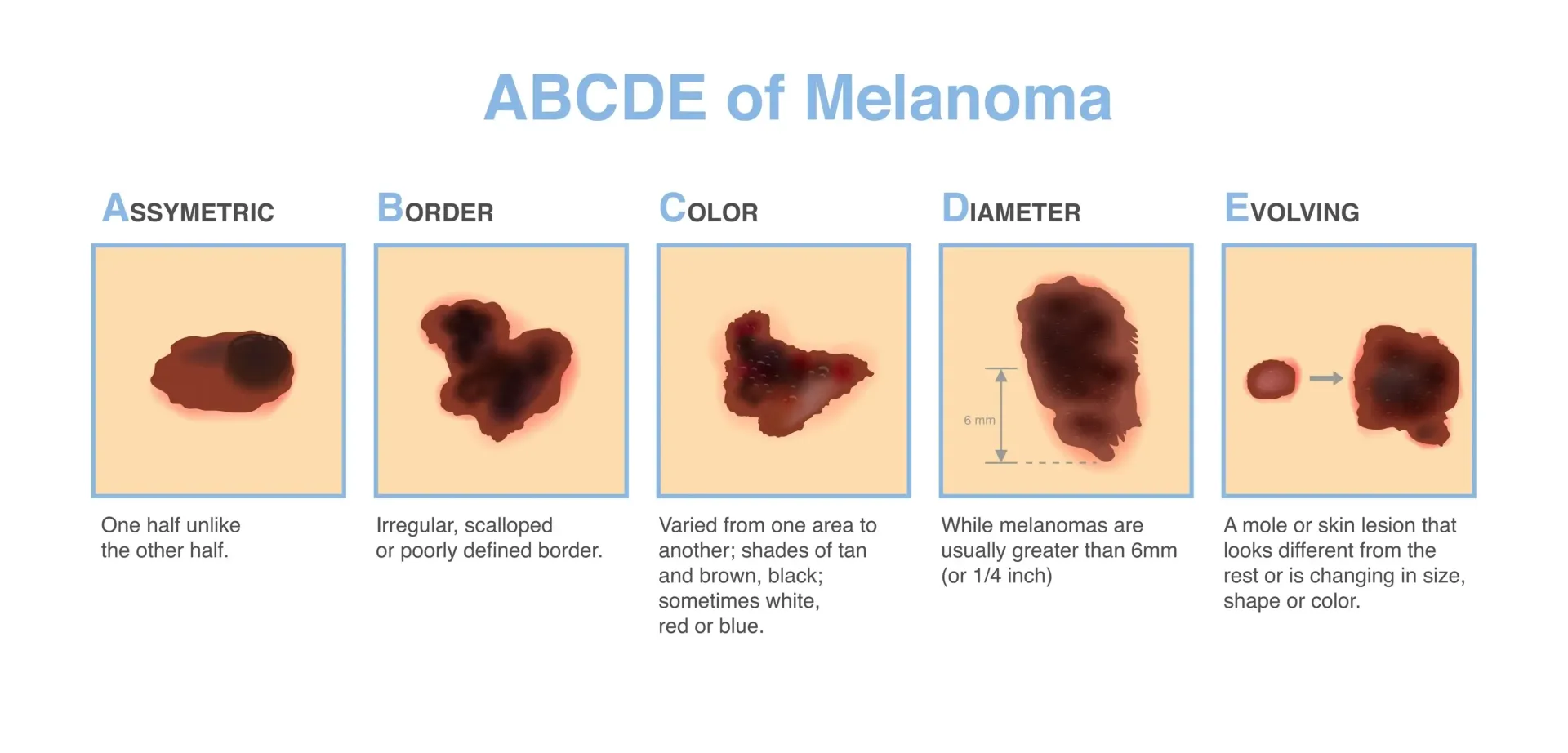 Diagram of the ABCDEs of Melanoma, showing the characteristics of a potential skin cancer: Asymmetry, Border, Color, Diameter, Evolving.