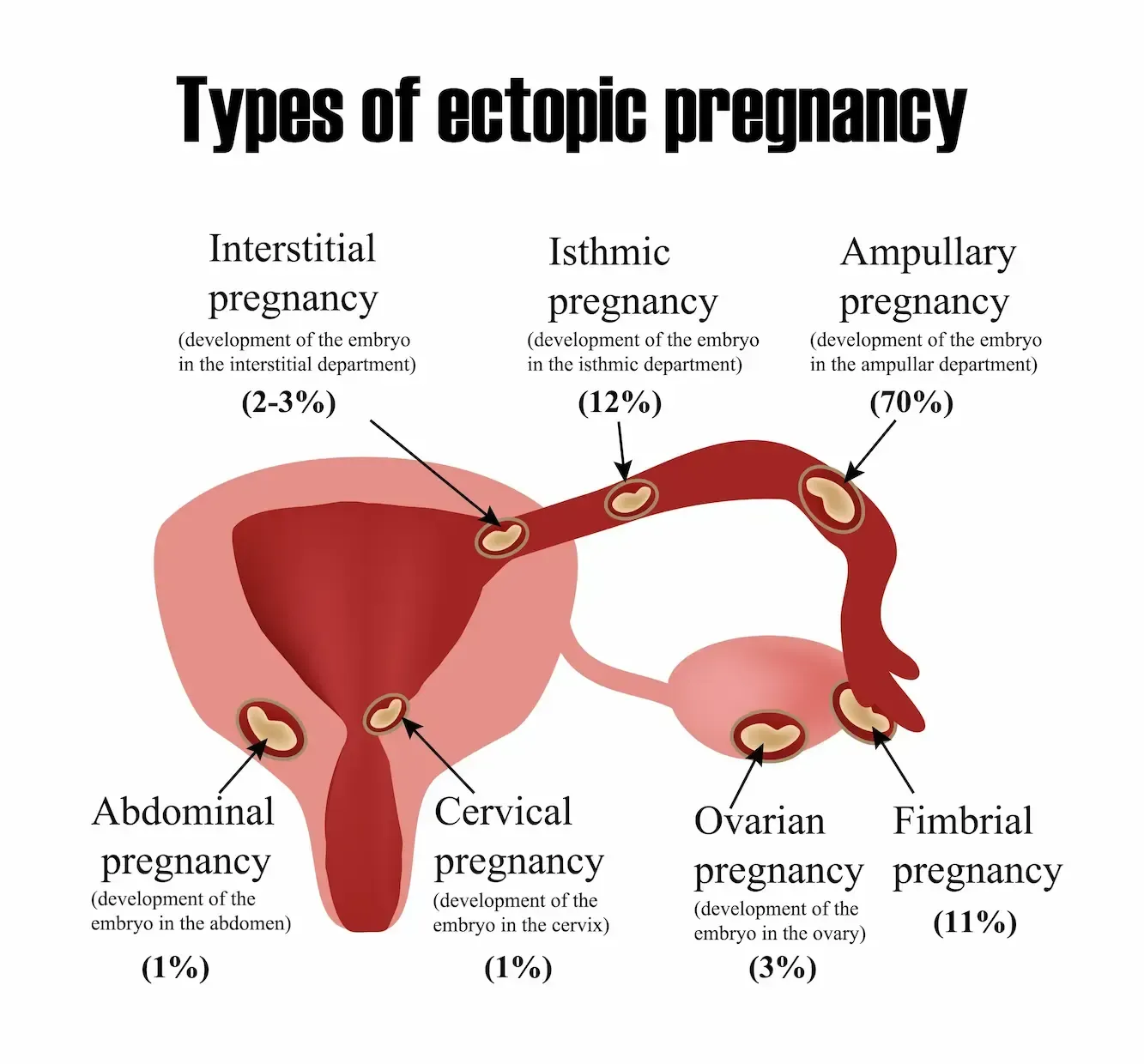 Diagram of female reproductive system illustrating types of ectopic pregnancy: interstitial, isthmic, ampullary, abdominal, cervical, ovarian, and fimbrial.