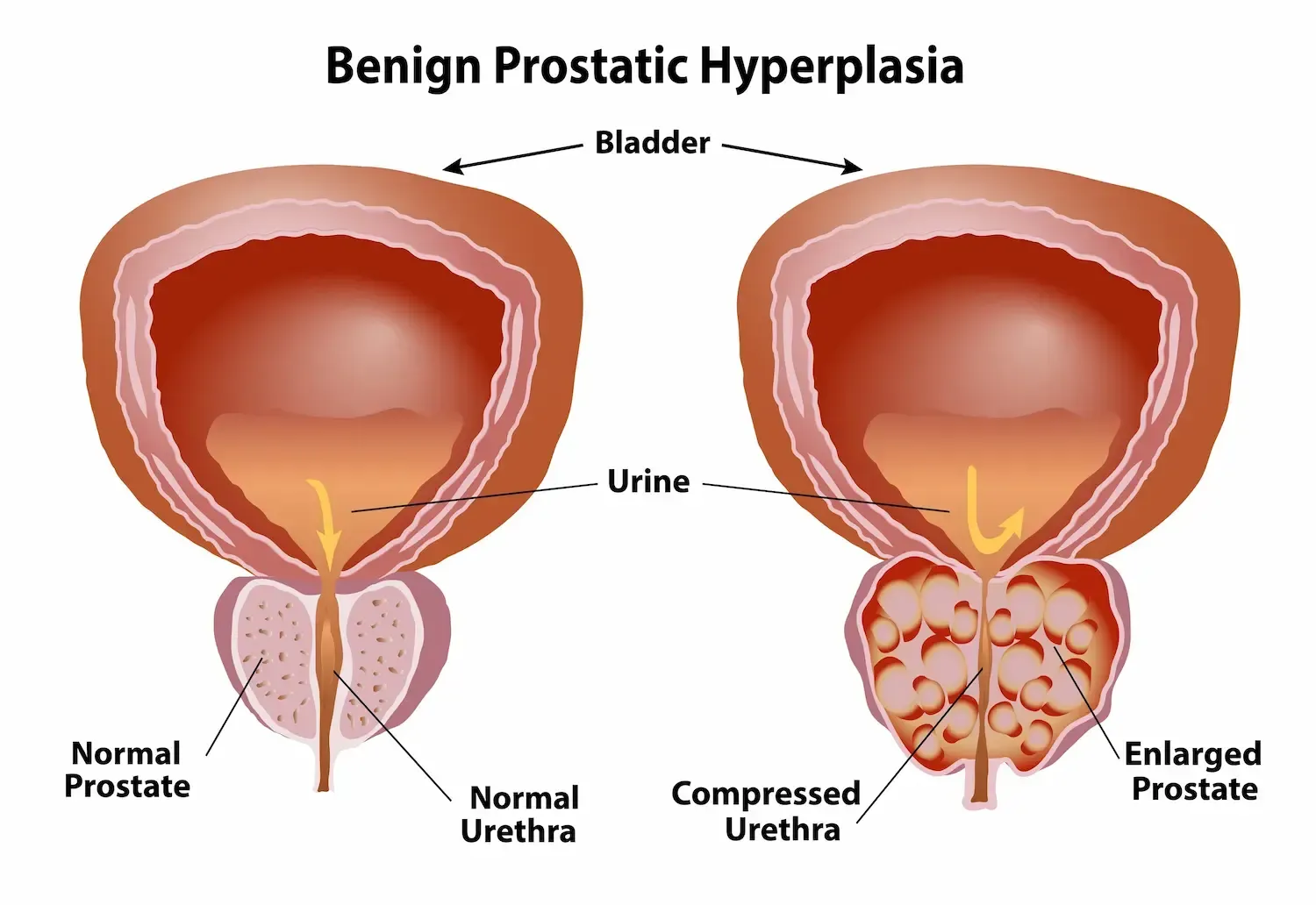Diagram comparing normal and enlarged prostate, showing bladder, urethra, and urine flow.