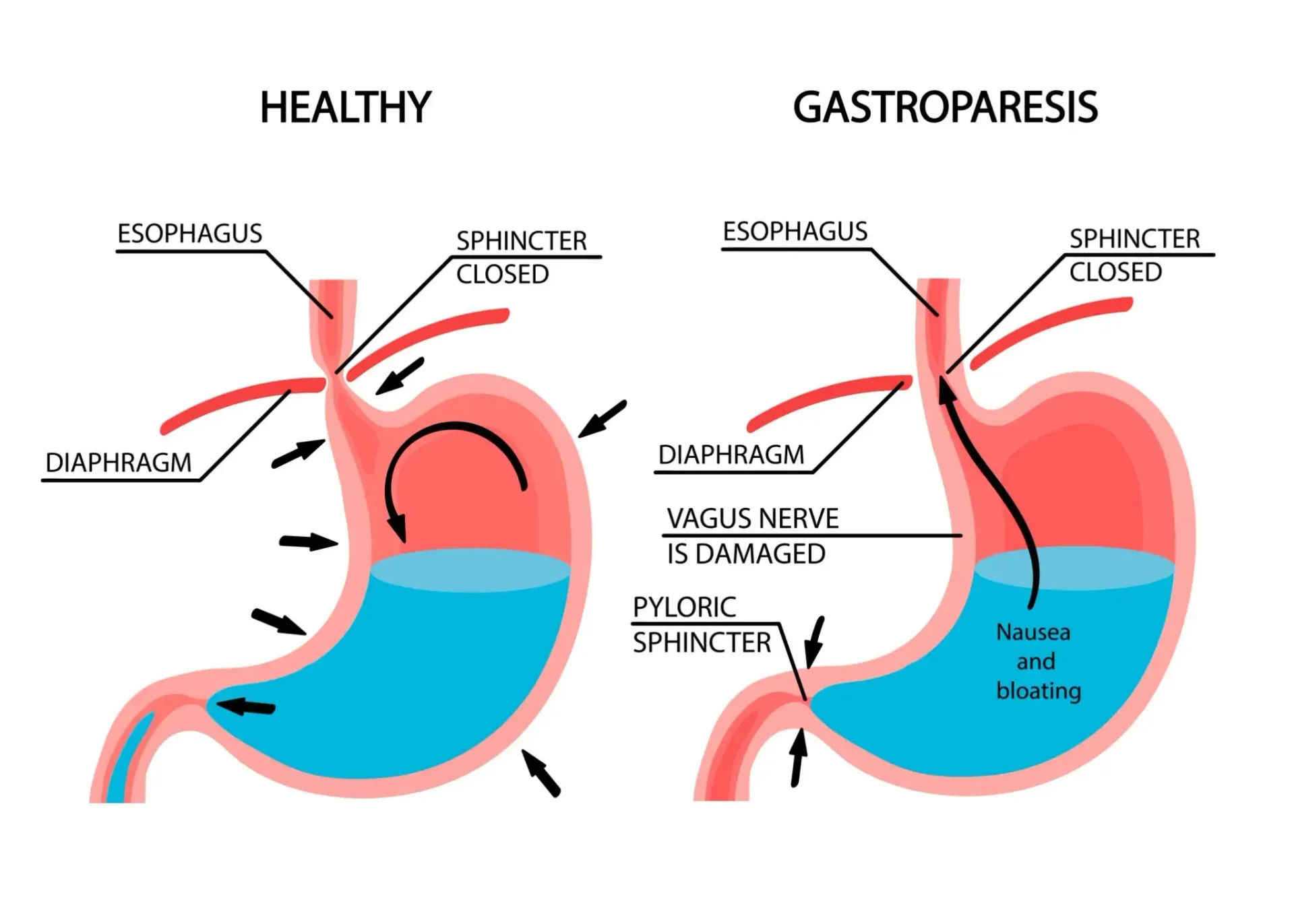 Diagram comparing a healthy stomach to a stomach with gastroparesis, showing slowed gastric emptying.