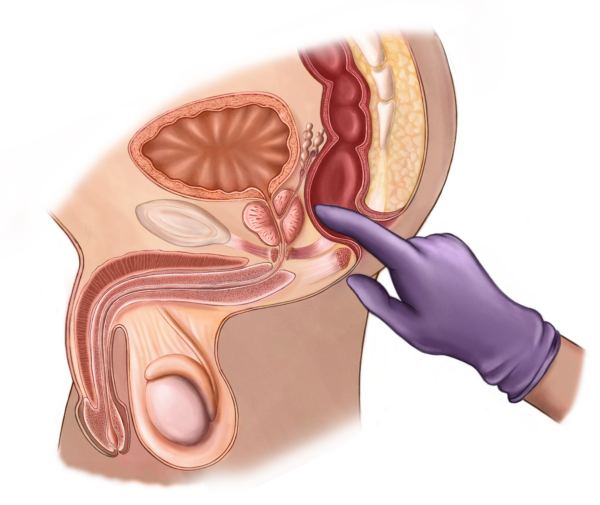 Diagram of a male pelvic area showing a gloved finger inserting into the rectum.