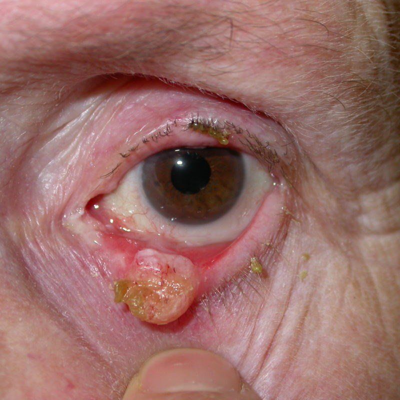 Eyelid-Tumour-Surgery-Newcastle