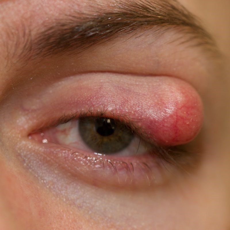 Eyelid-Lump-and-Bumps-Surgery-Newcastle
