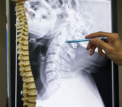 Hand pointing at an X-ray of a neck and head, with a model spine on the side.