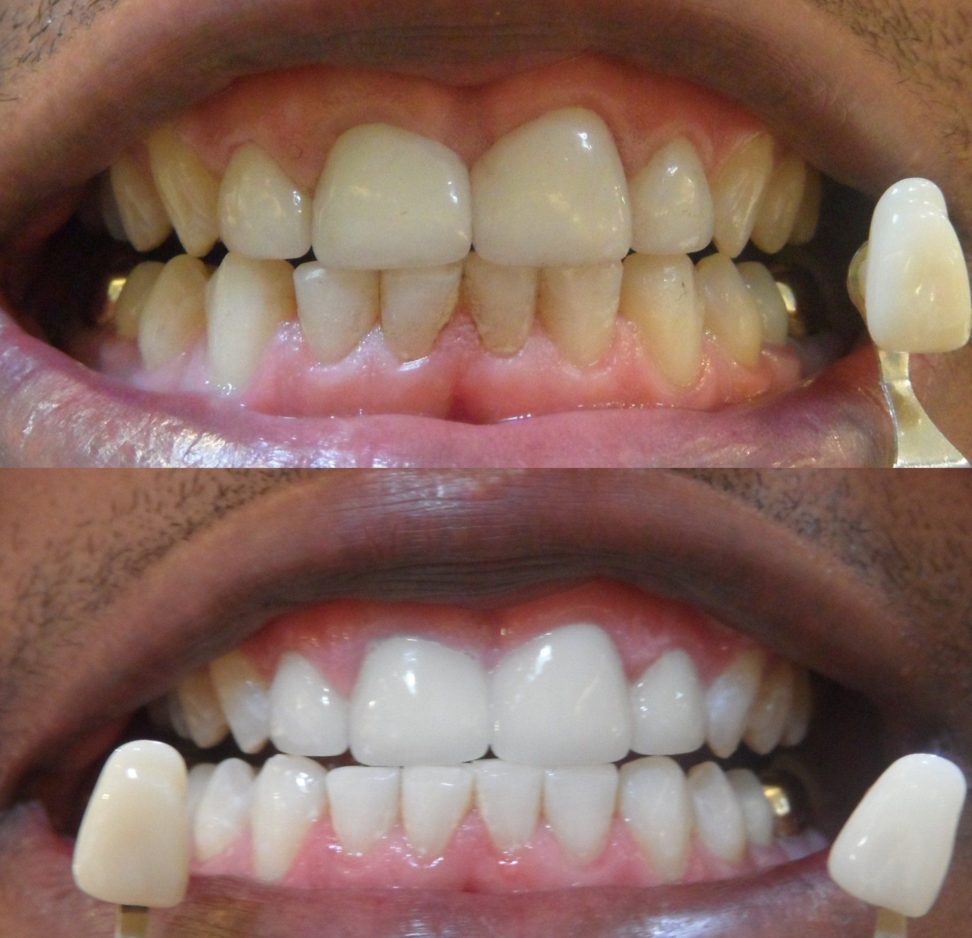 teeth whitening uv