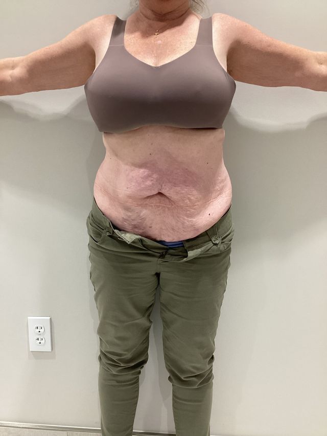 tirzepatide vs semaglutide weight loss studies Tirzepatide vs. Semaglutide: What's the Difference? When it comes to  medical weight management, two of the most trusted options today are  Tirzepatide (Mounjaro®/Zepbound®) and Semaglutide (Ozempic®/Wegovy®). Both  are weekly injections designed to