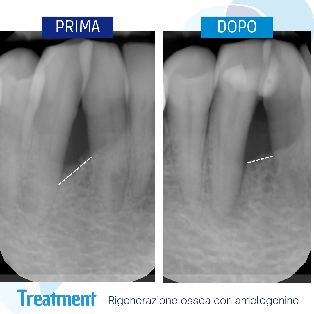 rigenerazione ossea con amelogenine