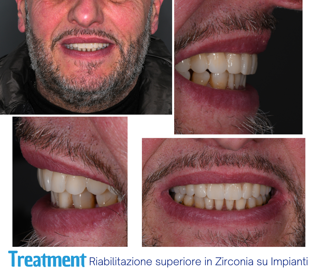 implantologia in zirconia a  Carico Immediato