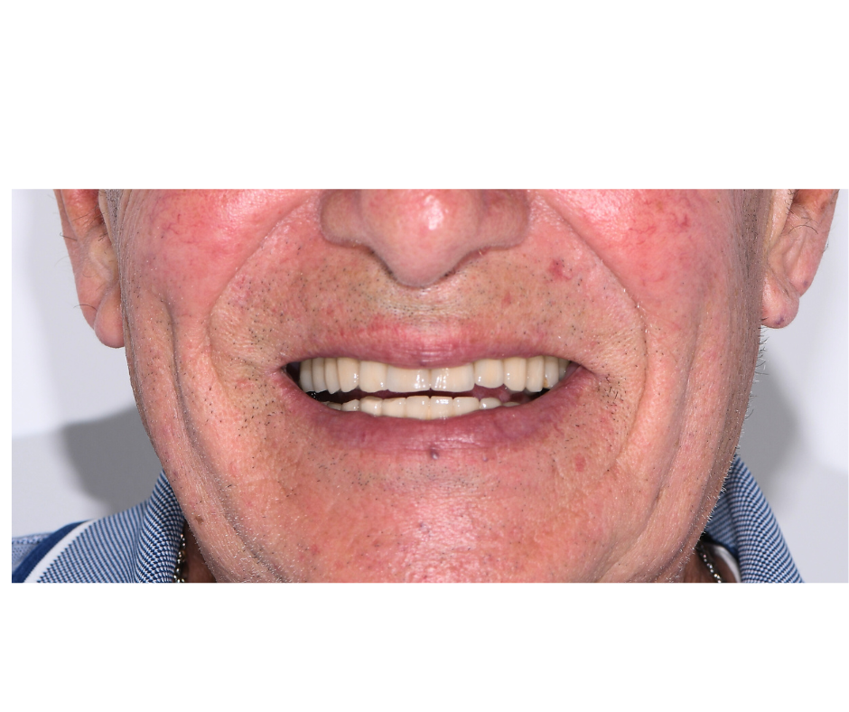 Caso di Iplantologia computer guidata presso la Clinica Odontoiatrica Barbiera