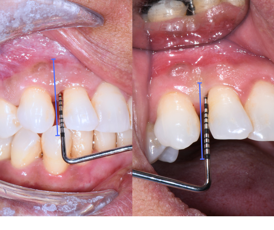 diagnosi piorrea con sonda parodontale misurazione tasche