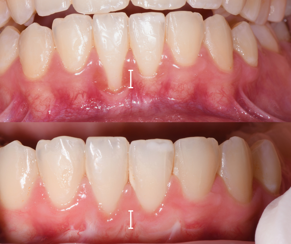 cure piorrea dopo terapia di scaling e rigenerazione gengivale