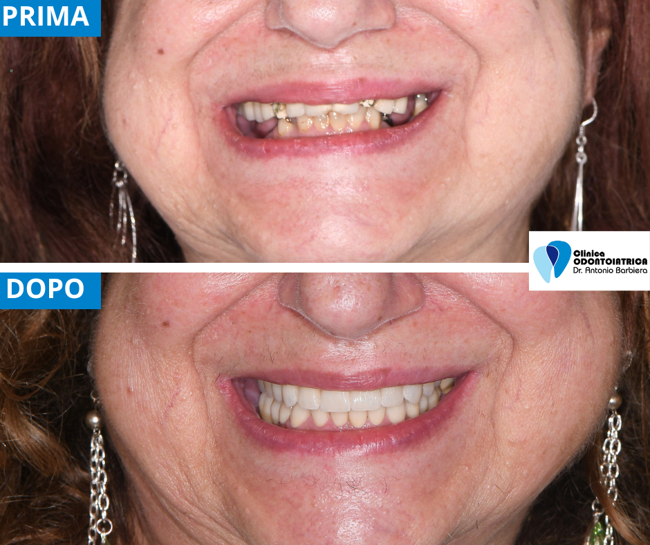 Caso prima e dopo in implantologia computer guidata