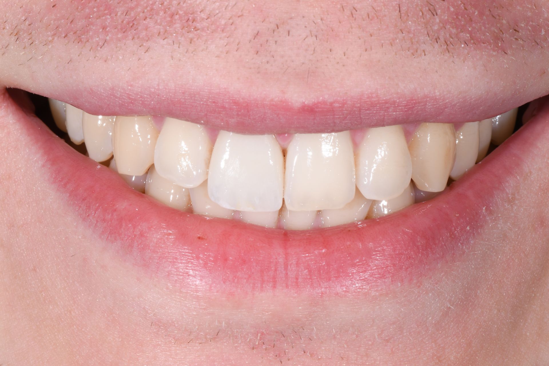 faccette dentali ceramica Partinico - Clinica Odontoiatrica Barbiera