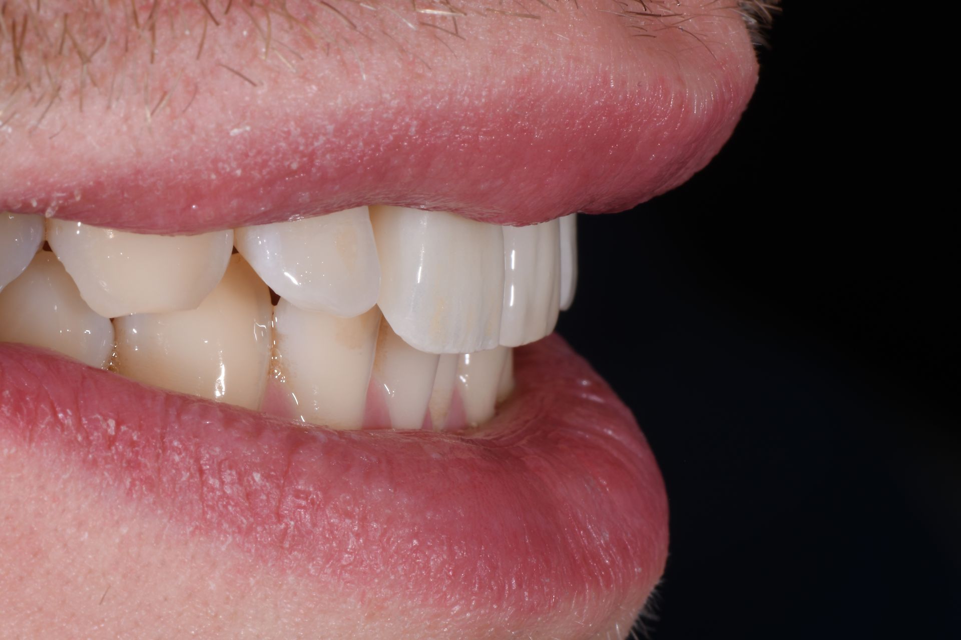 risultato faccette dentali - trattamento del dott. Barbiera Antonio Partinico