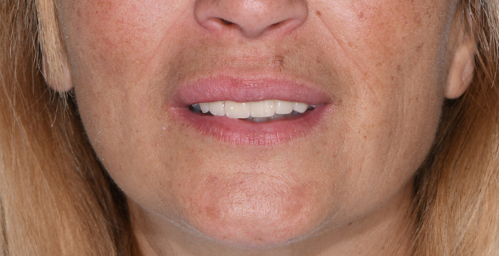 Faccette Dentali a PARTINICO