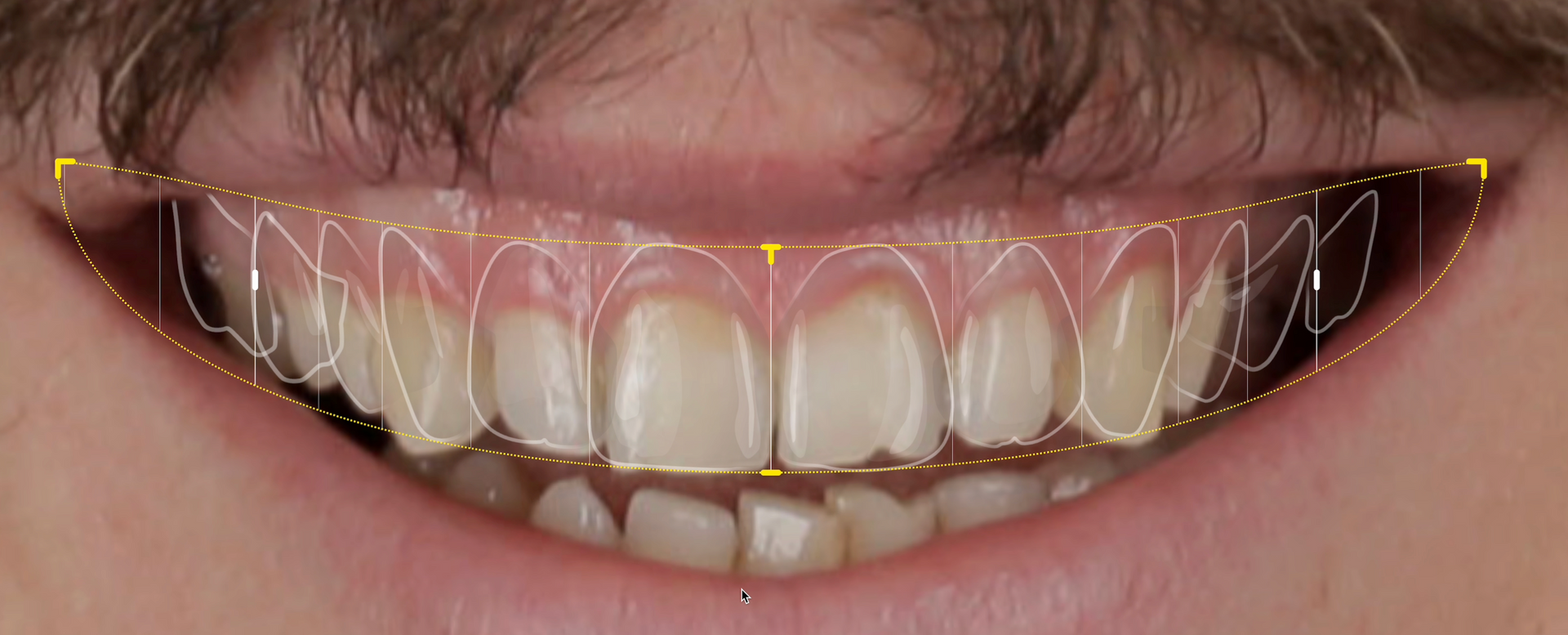 progettazione forma con il digital smile design