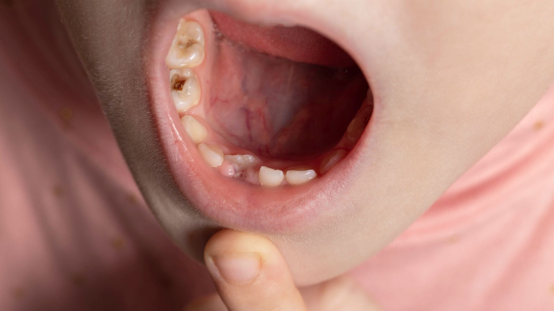 Un primo piano della bocca di un bambino a cui manca un dente.
