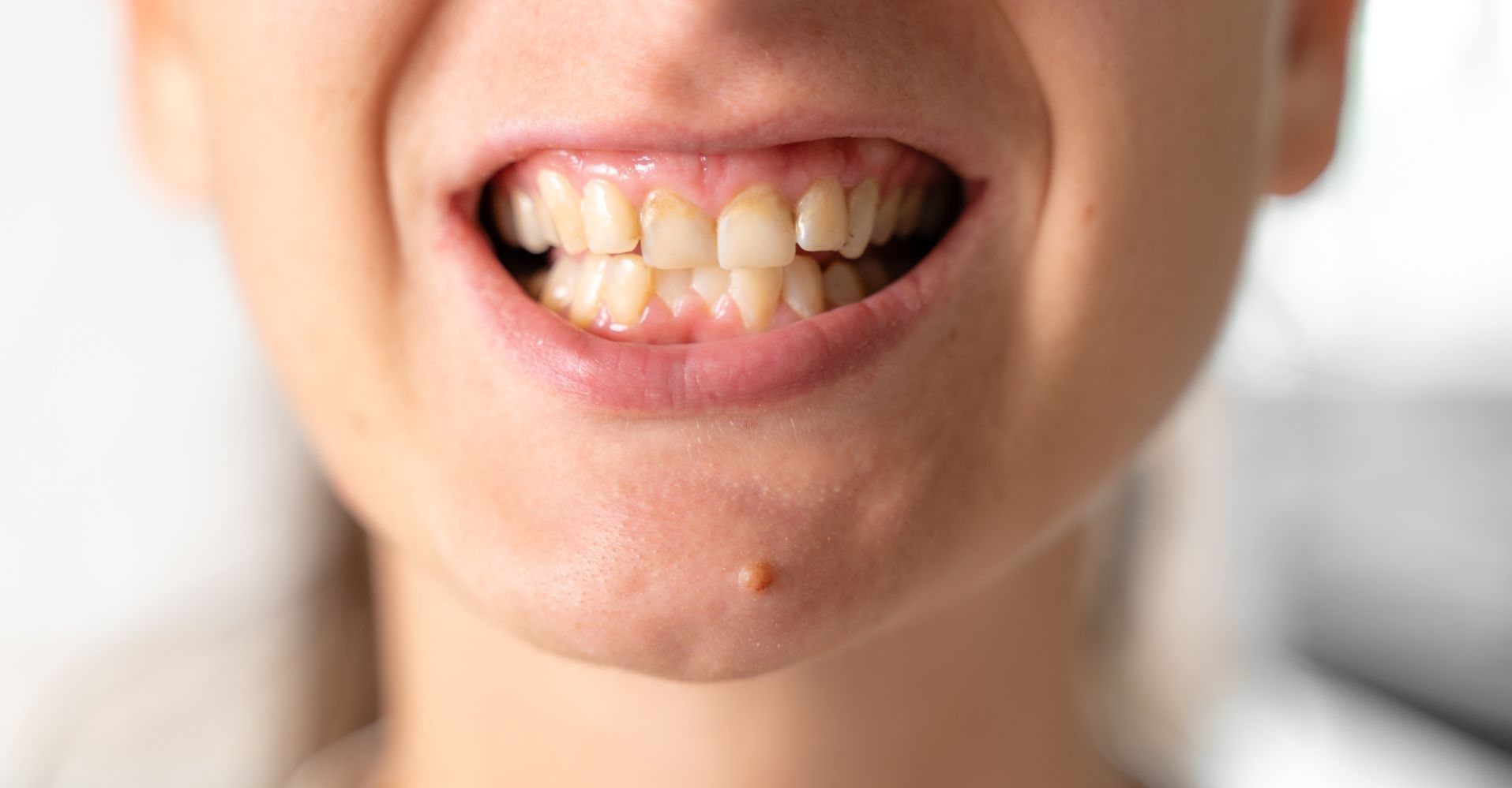 Un primo piano della bocca di una persona con i denti in vista.