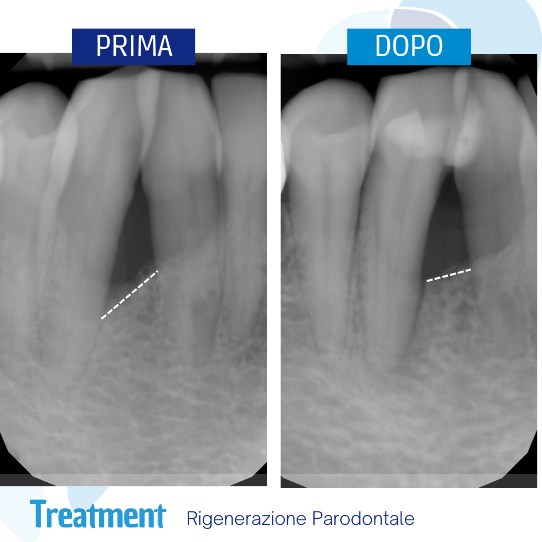 Piorrea Cura: Tasca ossea guarita dopo terapia parodontale