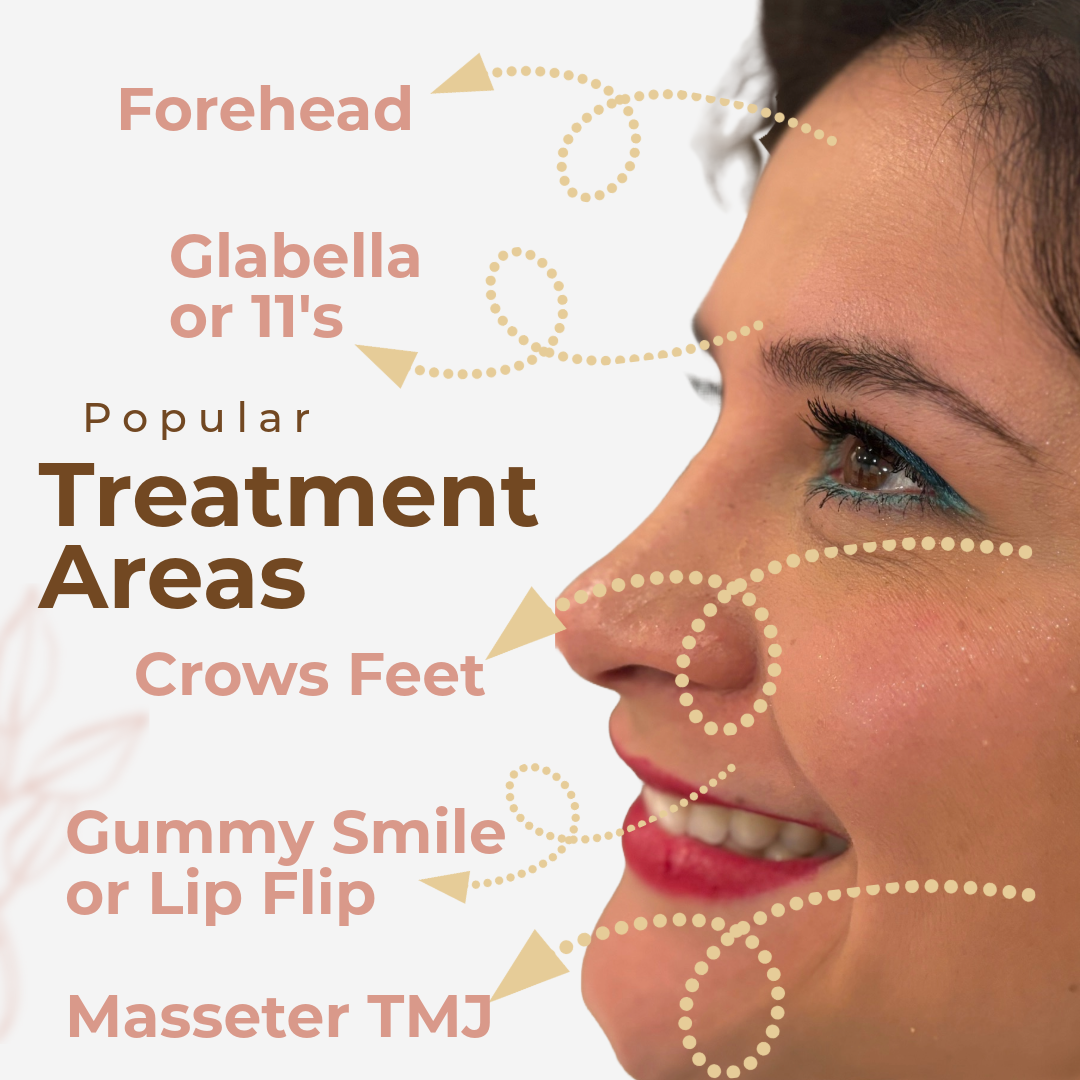 treatment areas for botox and brotox, forehead, 11's or glabella lines, crows feet, gummy smile, TMJ