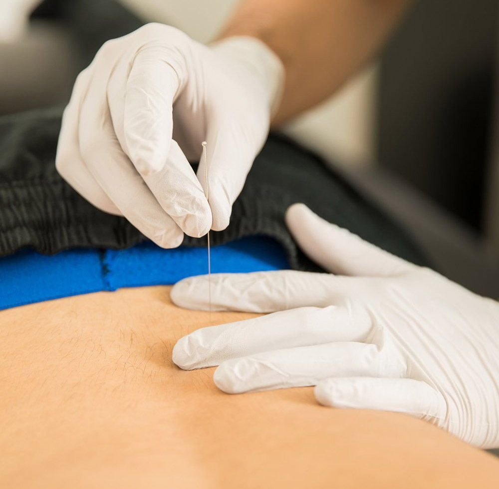 Doing Dry Puncture on the Back — Dry Needling in Port Stephens, NSW