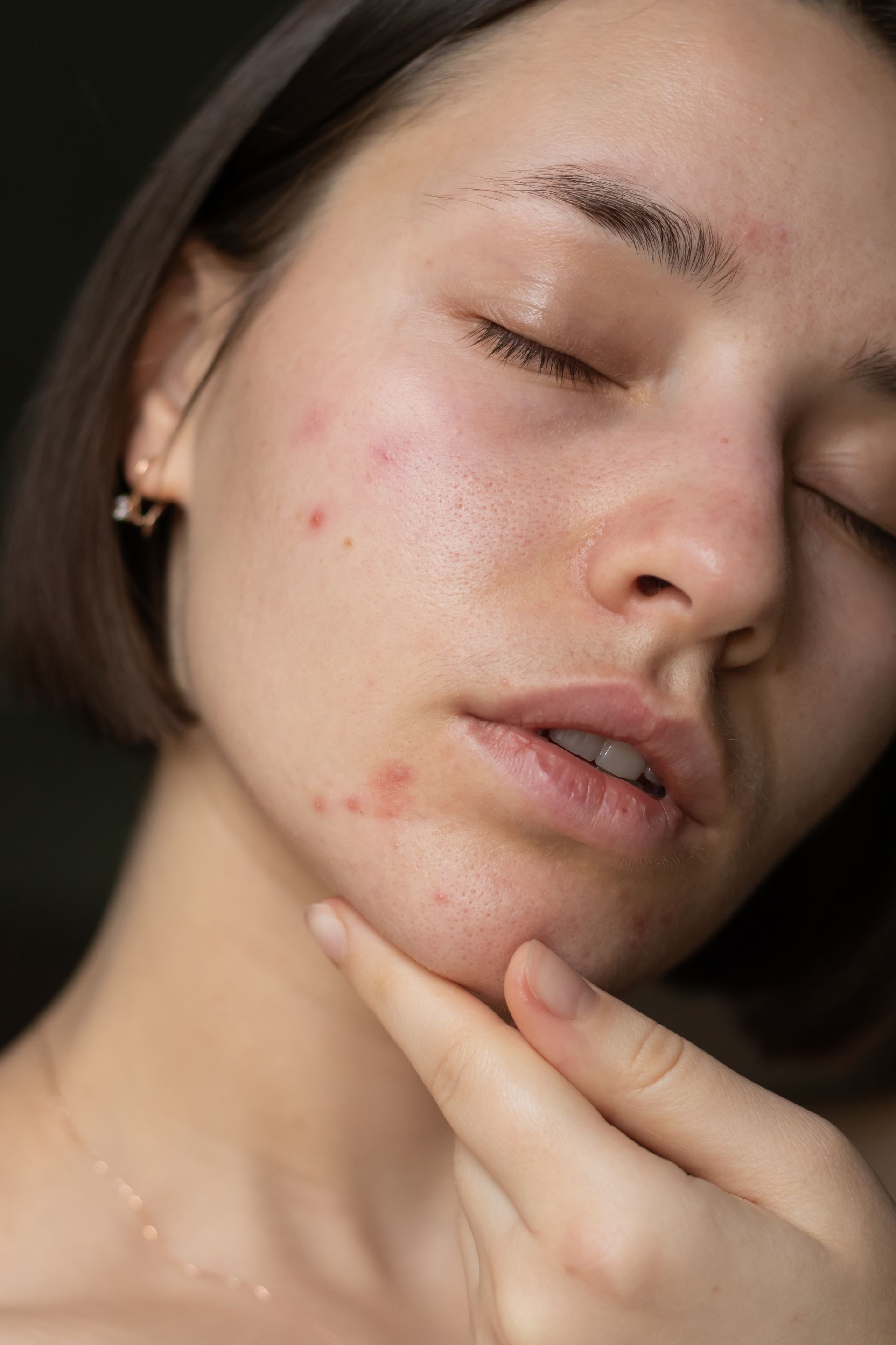 A woman with acne on her face is touching her face with her hand.