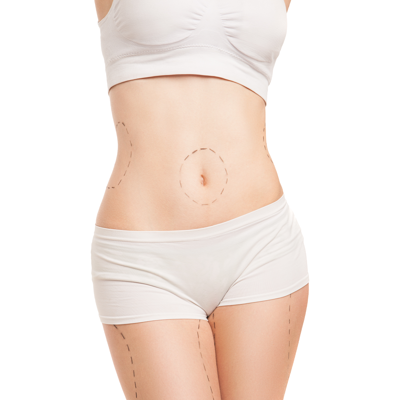 Woman's torso in white undergarments with surgical markings on abdomen, waist, and thighs.