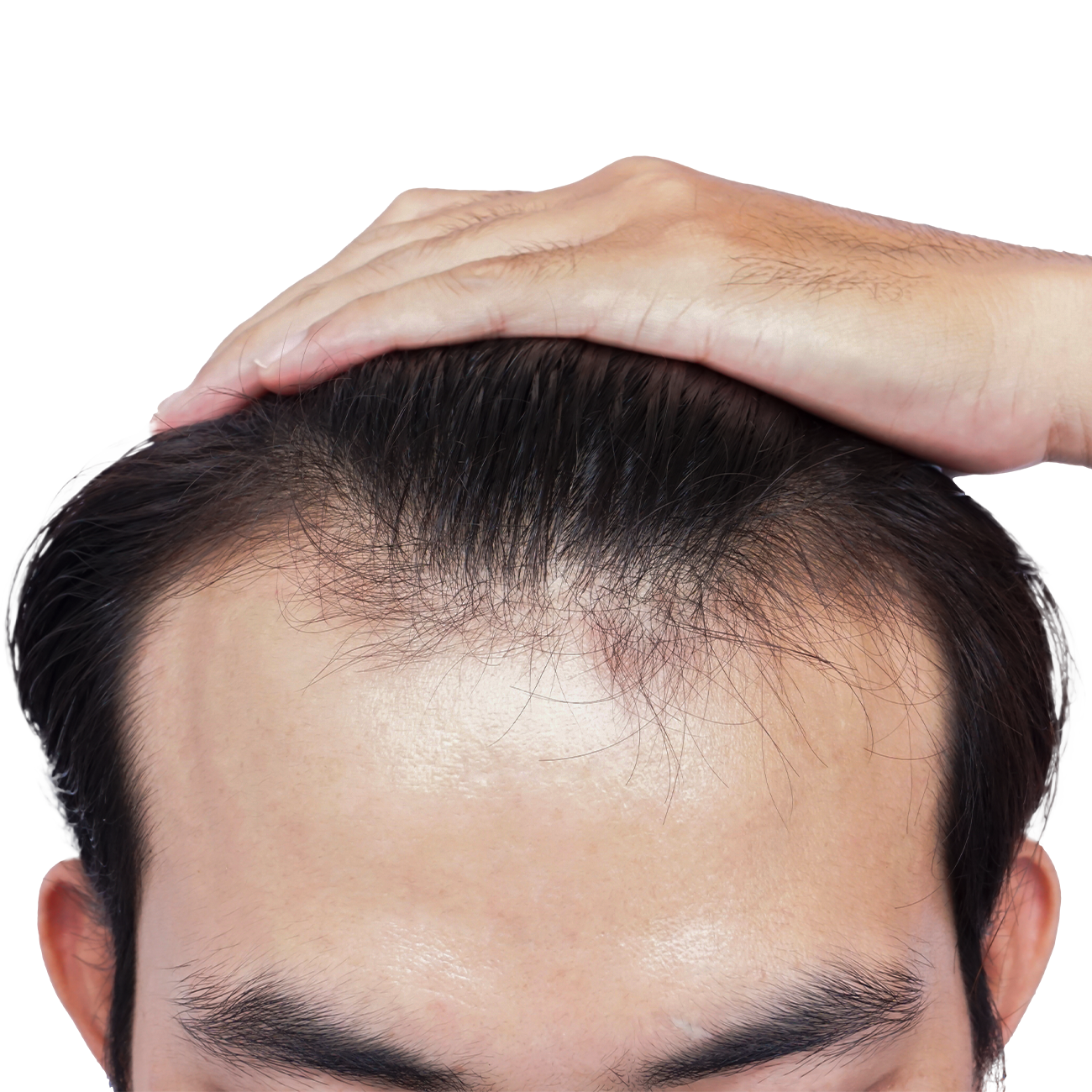 Man's hairline receding, hand on head, frontal view.