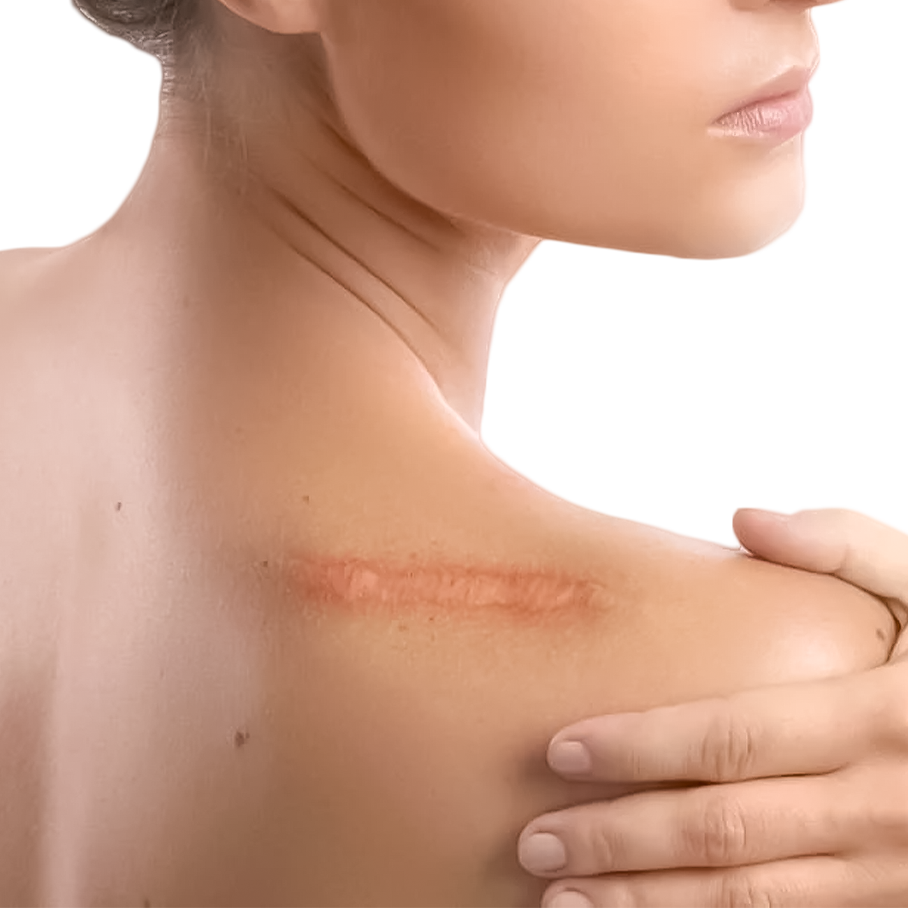 Woman's shoulder with a raised, reddish scar. A hand touches the shoulder.