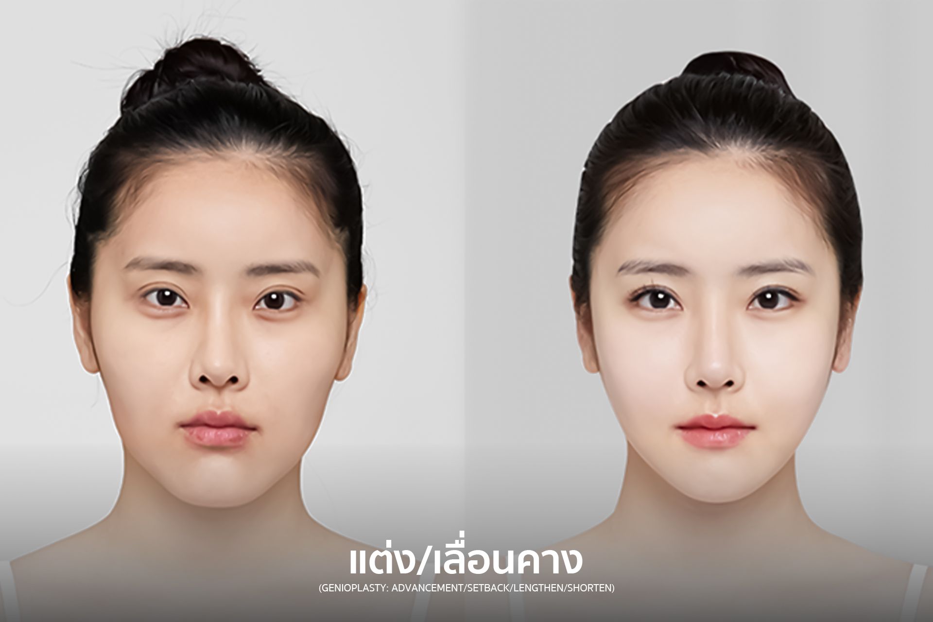 Side-by-side view of a face before and after cosmetic surgery, with a smaller jaw and enhanced features.