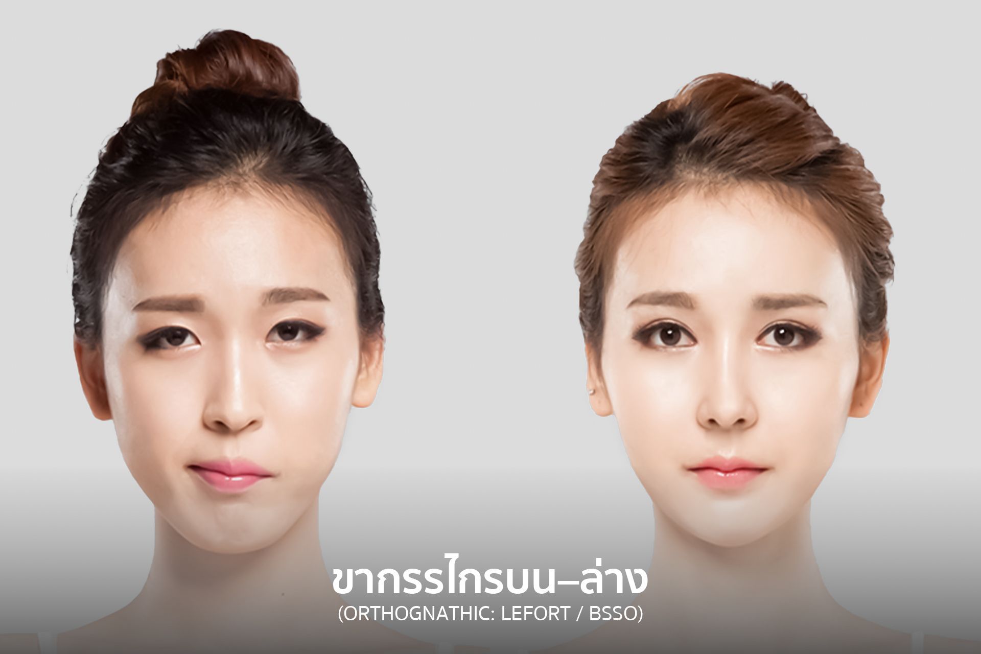 Side-by-side portraits: Before and after jawline surgery, with a more refined jaw in the after image.