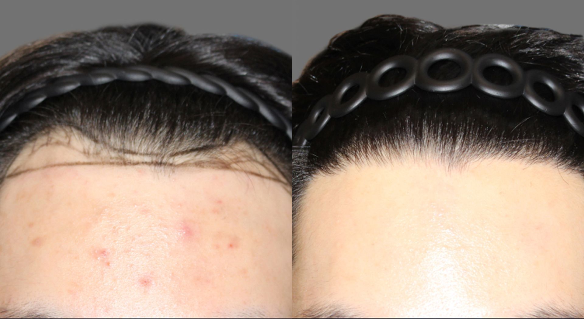 Forehead before and after treatment, showing acne and clearer skin with a hairline.