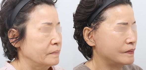 Comparison of two side-profile faces, possibly before/after a procedure, showing skin texture difference.