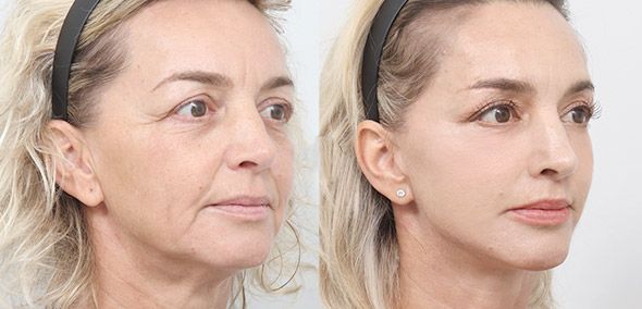 Side-by-side comparison of a woman's face before and after a cosmetic procedure, showing reduced wrinkles.