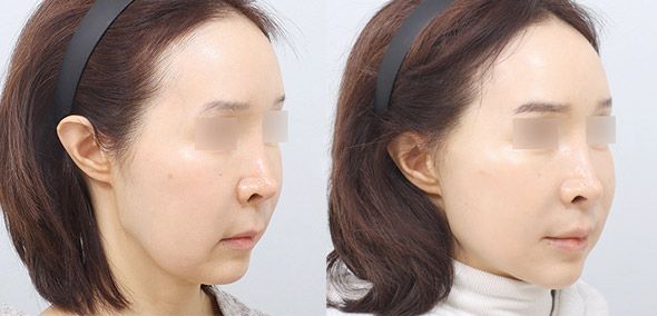 Side-by-side view of a person before and after a cosmetic procedure, showing changes in the jawline.