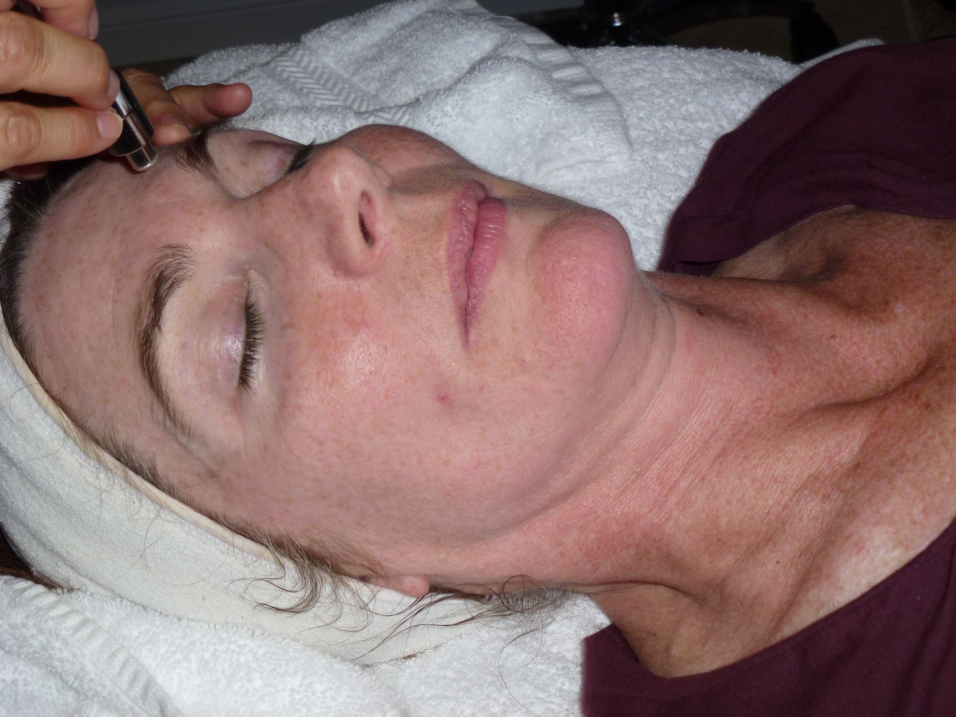 Woman receiving facial treatment, with tool near eyebrow, lying on a white towel.