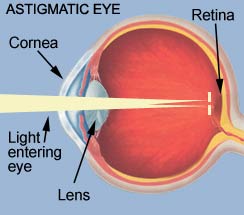 Astigmatic eye - Complete Vision Care in Amherst NY