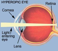 Hyperopic eye - Complete Vision Care in Amherst NY