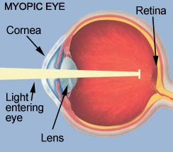 Myopic eye - Complete Vision Care in Amherst NY