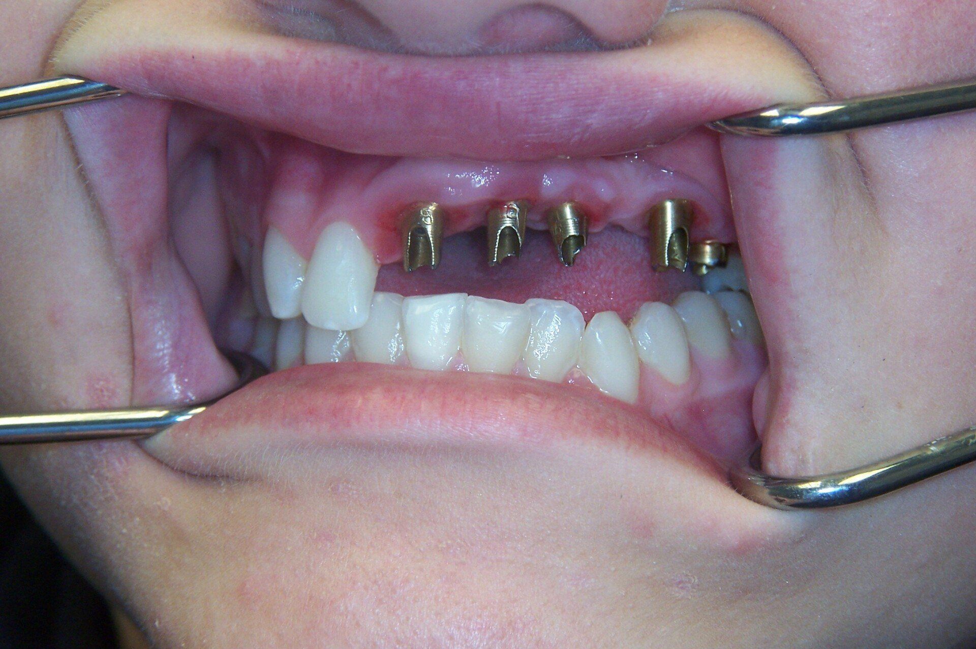 A close up of a person 's mouth with dental implants in it.