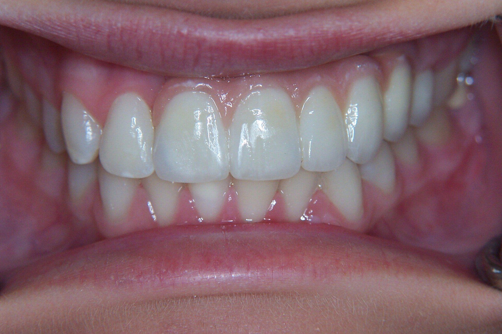 A close up of a person 's teeth with white teeth.