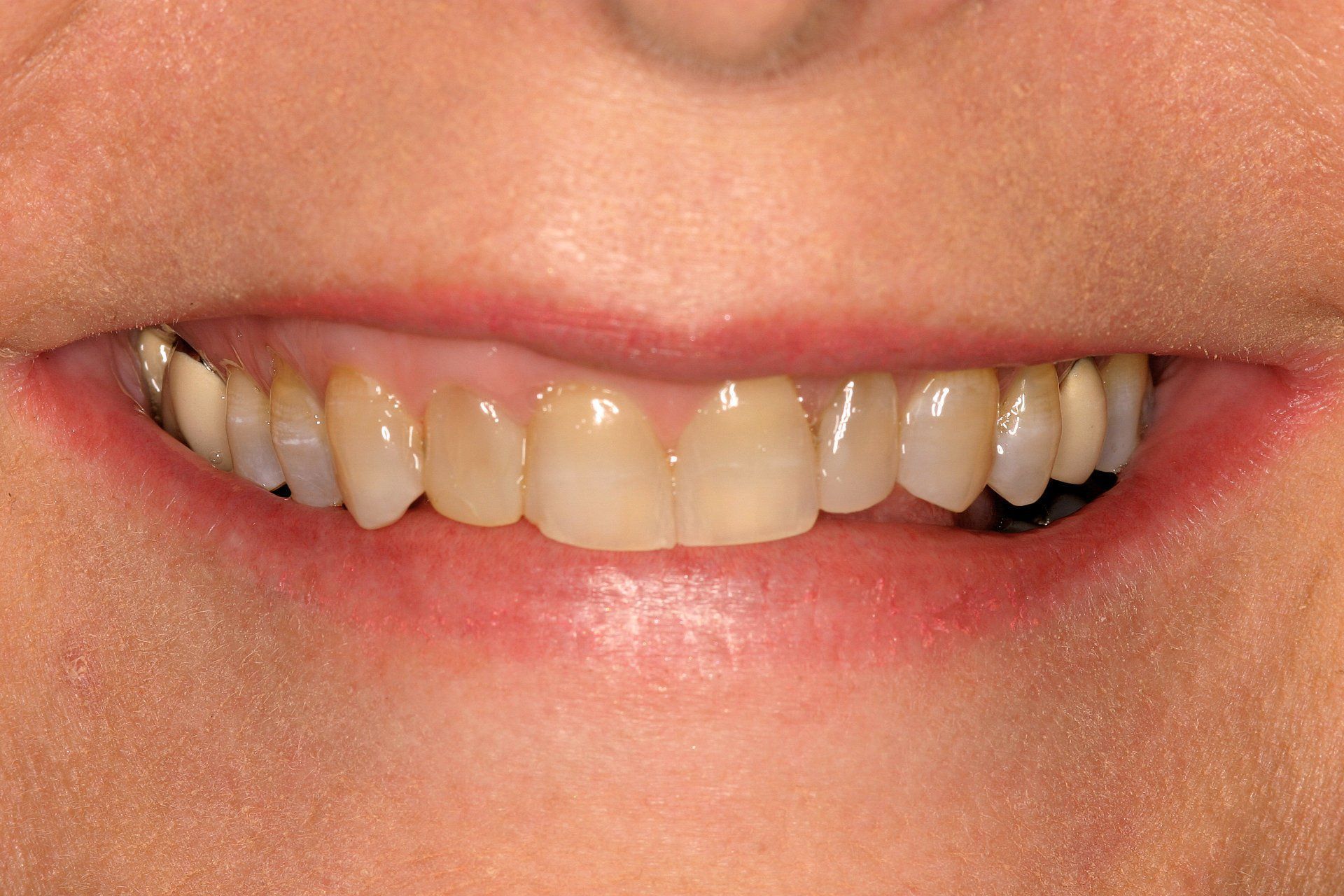 A close up of a woman 's smile with a broken tooth.