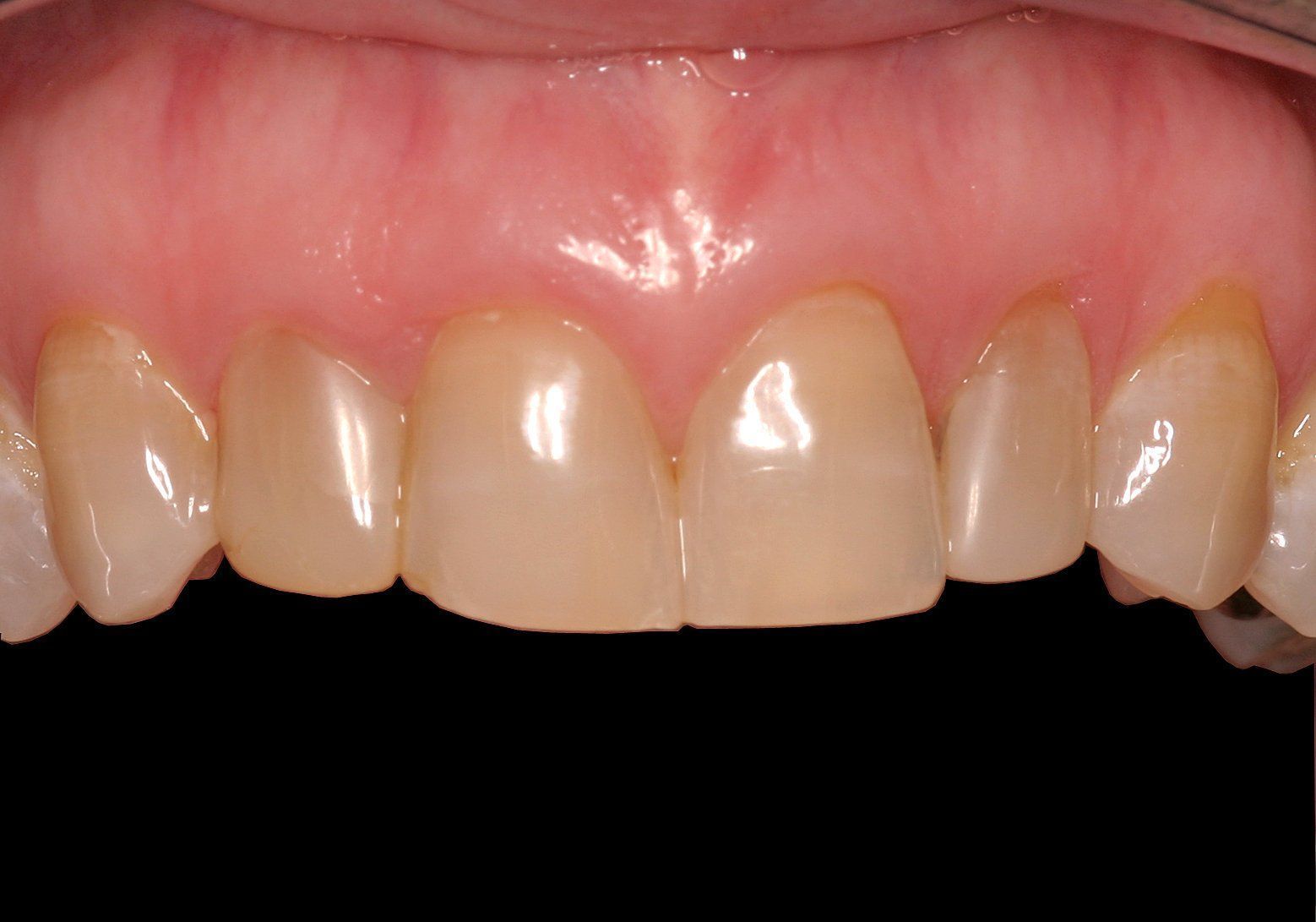 A close up of a person 's teeth with a black background.