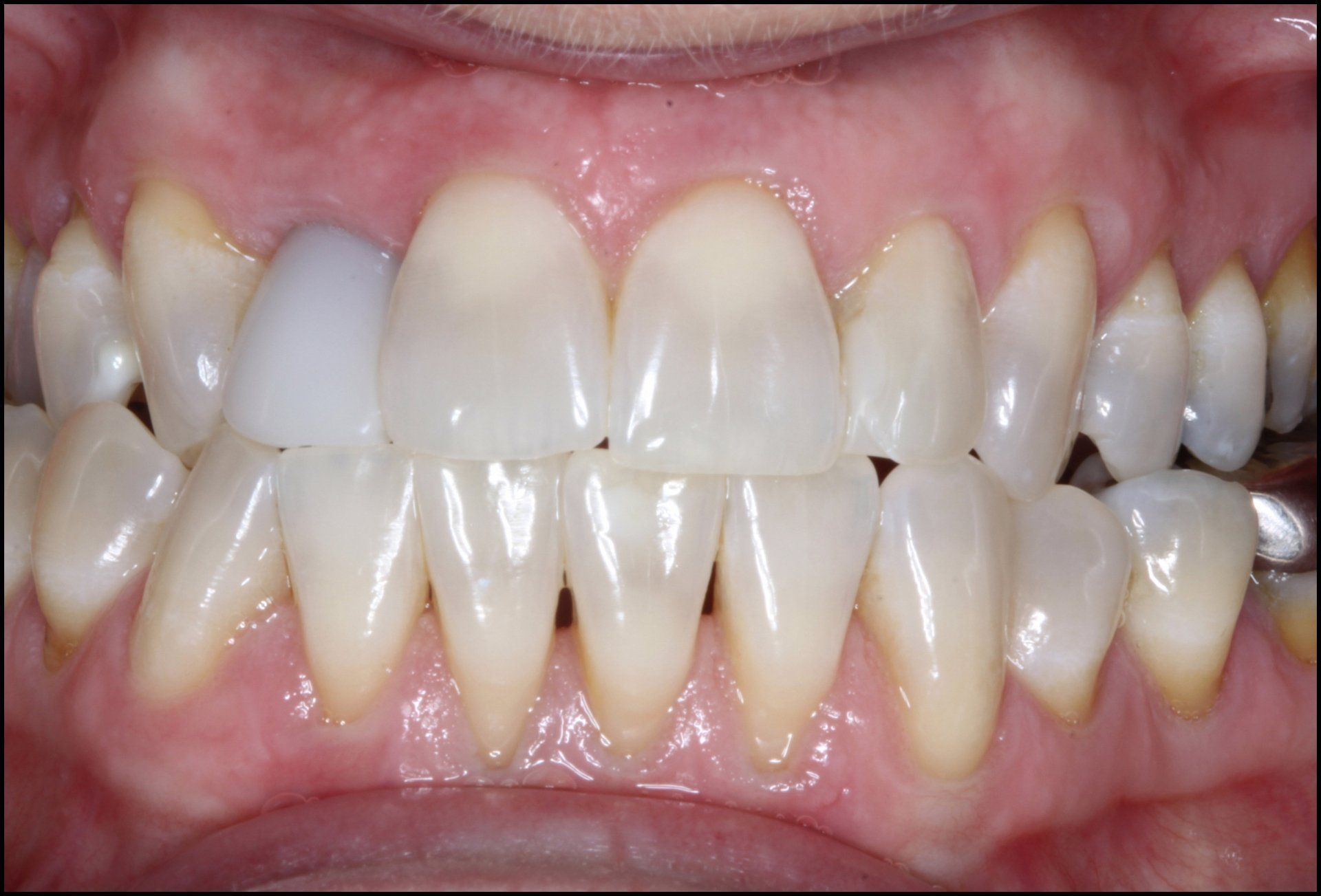 A close up of a person 's teeth with white teeth.